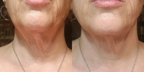 Before and After Firming Neck Treatment us min